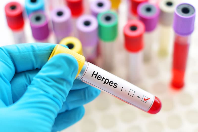 can-genital-herpes-be-cured-uk-meds