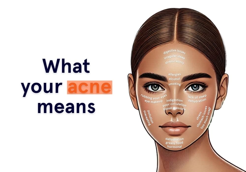 The potential causes of acne